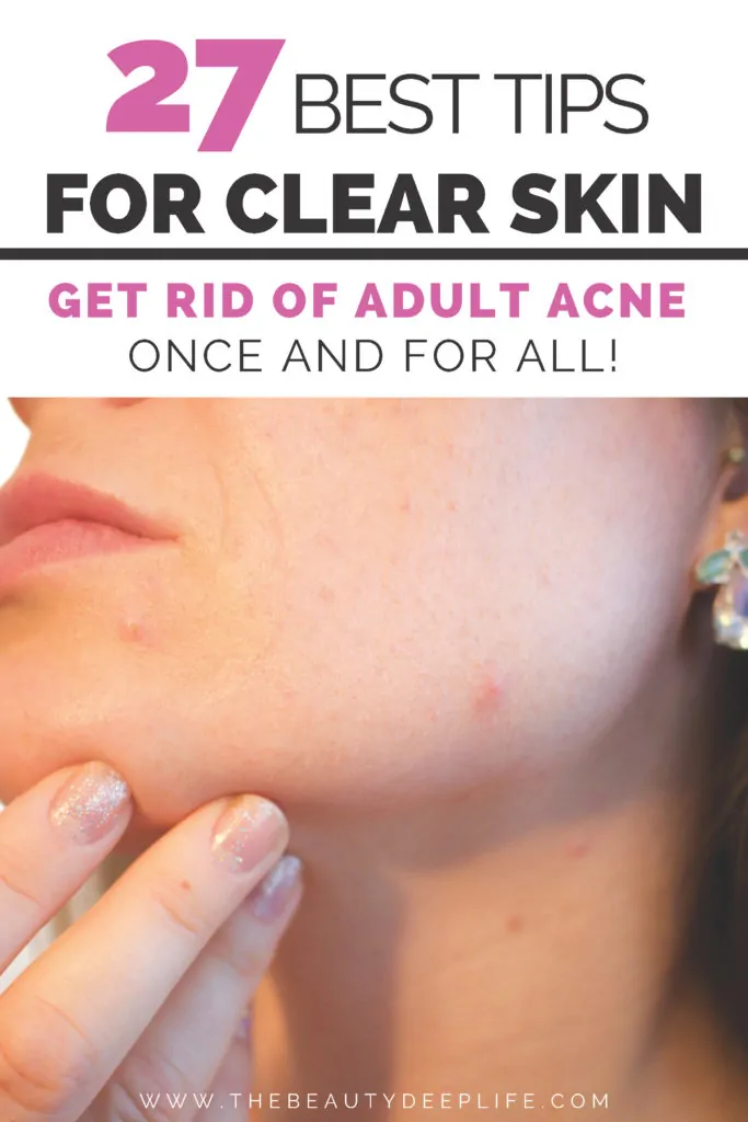 woman's face with acne text overlay - 27 best tips for clear skin get rid of adult acne once and for all