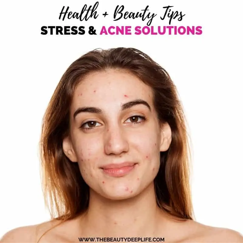 woman with acne and text overlay stress and acne solutions
