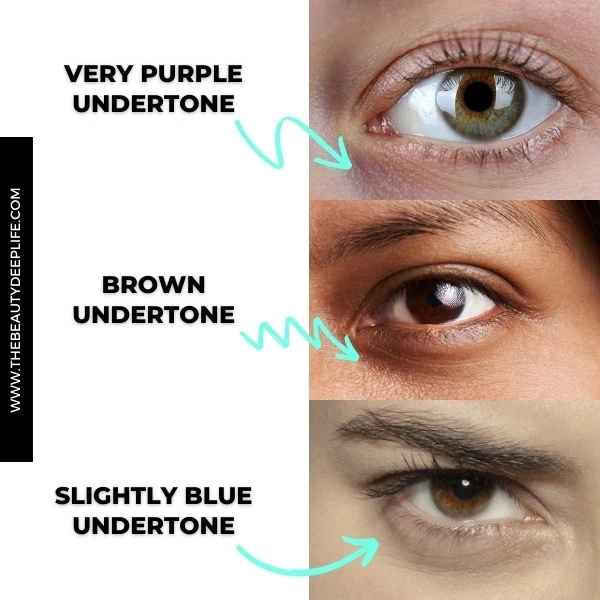 concealer chart with examples of different dark under-eye circles and their undertones